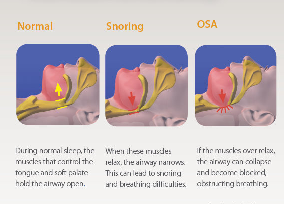Bondi Junction Dental » Simple Snoring Without Apnoea