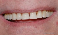 Picture28 p8 half worn smile restored after-1