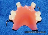 Part plastic upper denture