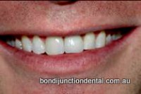 After: Tooth whitening, implant crown and veneer