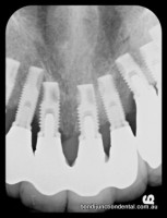 Multiple implants placed by specialist oral surgeon and restored by Dr Deutsch