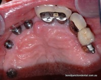 Four implants placed into upper right arch