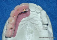 Laboratory stage: Hybrid denture construction using four implants. Access holes are filled in after insertion