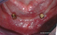 After: two implants with press stud type attachments that clip into undersurface of a full lower denture 