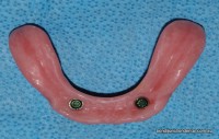 Press studs in dentures clip onto studs in implants 
