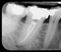 Molar tooth with one root, two canals that fuse into one